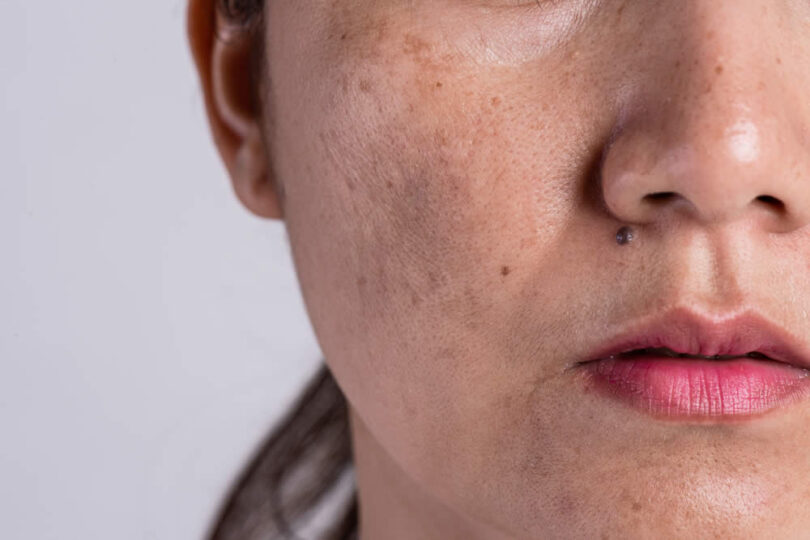 Óleo essencial para Melasma